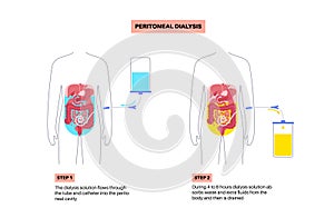Peritoneal dialysis concept