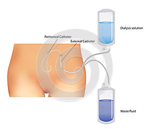 Peritoneal dialysis. Renal insufficiency.