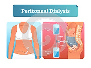 Peritoneal dialysis vector illustration. Labeled method to exchange fluids.