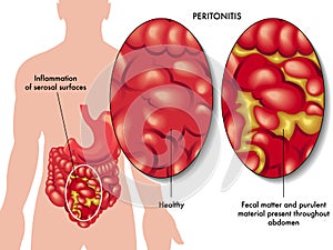 Peritonitis photo