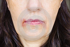 Perleche perioral dermatitis woman mouth photo