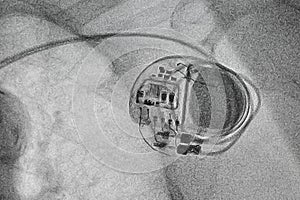 Permanent pacemaker x-ray image
