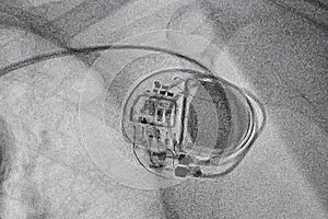 Permanent pacemaker x-ray image