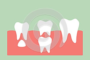 Permanent tooth located below primary tooth