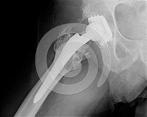 Permanent total hip arthroplasty xray