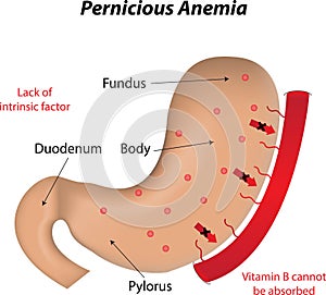 Pernicious Anemia photo