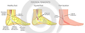 Peroneal Tendon Injuries_Peroneal tendonitis