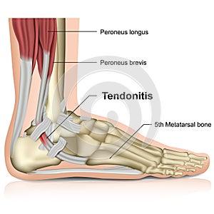 Peroneal tendonitis ,ankle joint 3d medical  illustration
