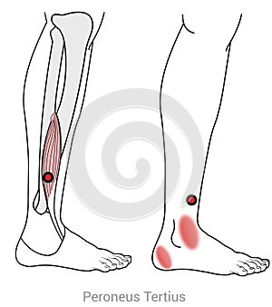 Peroneus tertius: Myofascial trigger points and referred pain locations