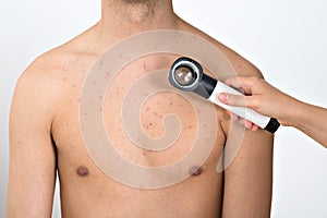 Person Examining Acne Skin With Dermatoscope