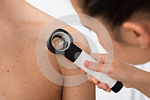 Person Examining Acne Skin With Dermatoscope