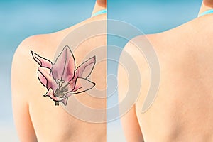 Person Showing Laser Tattoo Removal Treatment On Shoulder