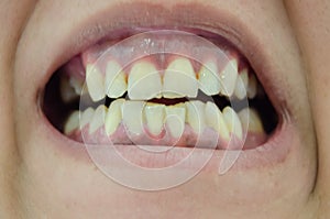 Person showing very ugly broken and yellow teeth