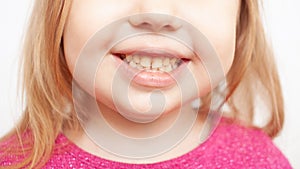 person smiles, shows teeth, yellow plaque, crooked teeth, malocclusion. childhood