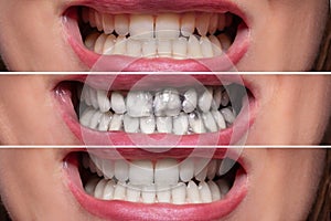 Person Teeth Before And After Cleaning photo