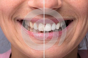 Person Teeth Before And After Whitening