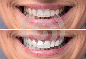 Person Teeth Before And After Whitening photo