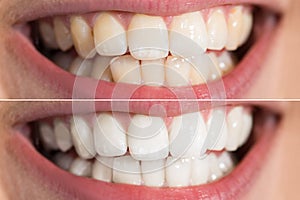 Person Teeth Before And After Whitening photo