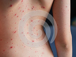 Persons back with chickenpox (varicella) blisters on his skin