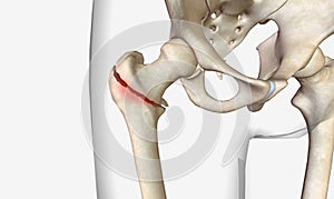 A pertrochanteric fracture is a hip fracture that is found in the trochanteric region of the femur