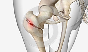 A pertrochanteric fracture is a hip fracture that is found in the trochanteric region of the femur