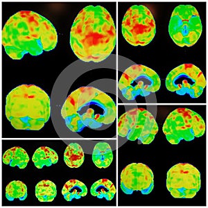 Pet ct alzheimer dementia pattern collage