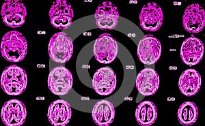 pet/ct of brain