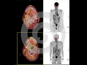 PET CT image of the Neck showing CA nasopharynx or carcinoma of nasopharynx from PET CT scannner