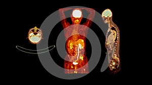 PET CT image of Whole human body  Axial ,coronal and sagittal plane. Positron Emission Computed Tomography
