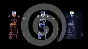 PET CT image of Whole human body  Axial ,coronal and sagittal plane. Positron Emission Computed Tomography