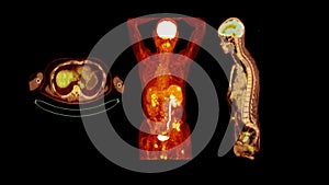 PET CT image of Whole human body  Axial ,coronal and sagittal plane. Positron Emission Computed Tomography