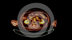 PET CT image of Whole human body  Axial  plane. Positron Emission Computed Tomography