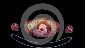 PET CT image of Whole human body  Axial  plane. Positron Emission Computed Tomography