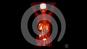 PET CT image of Whole human body  coronal plane. Positron Emission Computed Tomography