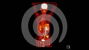 PET CT image of Whole human body  coronal plane. Positron Emission Computed Tomography