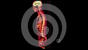 PET CT image of Whole human body   sagittal plane. Positron Emission Computed Tomography
