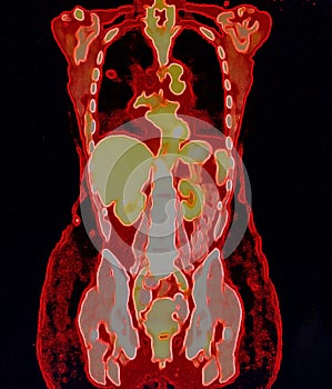 pet/ct of lung cancer