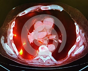 Pet ct right pleural metastatic disease