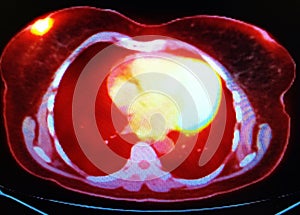 Pet ct scan breast periareolar carcinoma