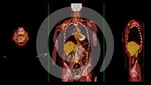 PET CT Scan fusion image It provides detailed images by merging