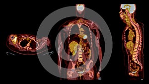 PET CT Scan fusion image It provides detailed images by merging