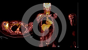 PET CT Scan fusion image It provides detailed images by merging