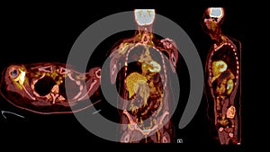 PET CT Scan fusion image It provides detailed images by merging