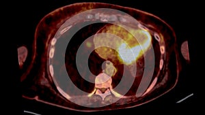 PET CT Scan fusion image It provides detailed images by merging