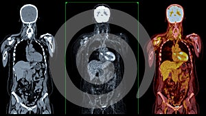 PET CT Scan fusion image It provides detailed images by merging