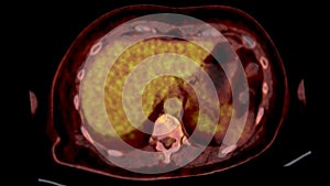 PET CT Scan fusion image It provides detailed images by merging