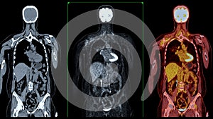 PET CT Scan fusion image It provides detailed images by merging