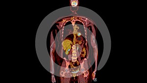 PET CT Scan fusion image It provides detailed images by merging