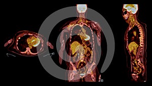 PET CT Scan fusion image It provides detailed images by merging