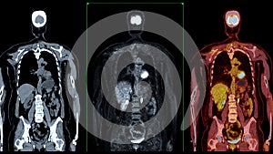 PET CT Scan fusion image It provides detailed images by merging